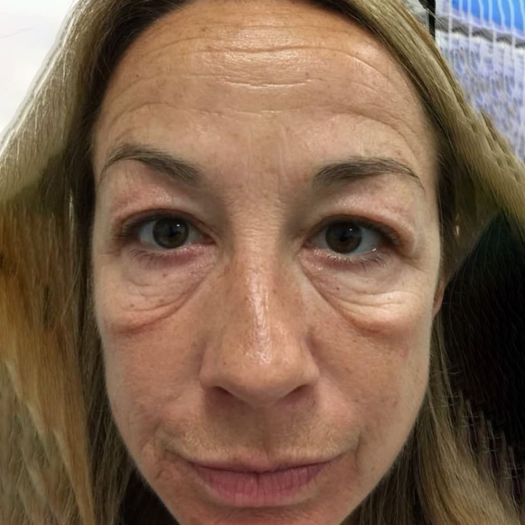 Patch occhi al collagene e peptidi